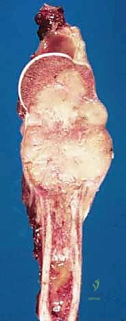 صورة طبية: استئصال العضد الداني وإعادة البناء بالطرف الاصطناعي: دليل شامل لمرضى أورام الكتف مع الأستاذ الدكتور محمد هطيف في صنعاء