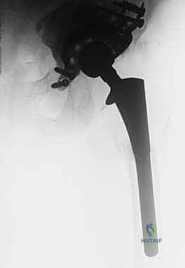 تصنيف بابروسكي لفقدان العظم الحقي