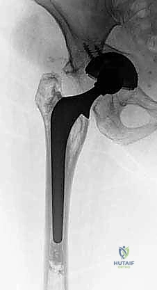 تأثير العدوى والتفكك على مفصل الورك