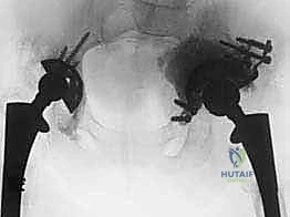 حالة بروز حقي شديد واختراق للحوض