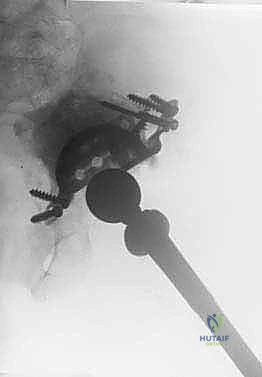 صورة توضح الفرق بين المفصل الأولي والقفص المضاد للبروز