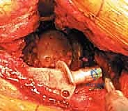 صورة توضيحية لـ مراجعة استبدال مفصل الورك الكلي بالقفص المضاد للبروز