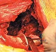 تصميم وشكل القفص المضاد للبروز