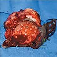 صورة طبية: مراجعة استبدال مفصل الورك الكلي بالقفص المضاد للبروز: حلول متقدمة لفقدان العظم الحقي الشديد مع الأستاذ الدكتور محمد هطيف في صنعاء