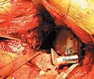 التشريح الدقيق للحوض ومفصل الورك