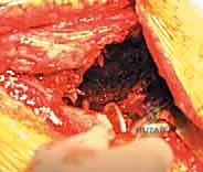 صورة شعاعية توضح تحلل العظم حول المفصل الاصطناعي