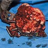 توضيح للأعصاب والأوعية الدموية المحيطة بمفصل الورك