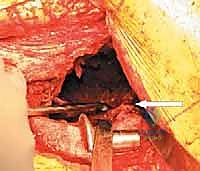 النهج الجراحي وفتح المفصل