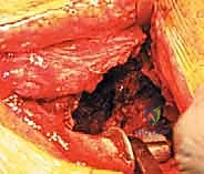 التخطيط الجراحي واستخدام النماذج المجسمة