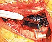 صورة طبية: مراجعة استبدال مفصل الورك الكلي بالقفص المضاد للبروز: حلول متقدمة لفقدان العظم الحقي الشديد مع الأستاذ الدكتور محمد هطيف في صنعاء