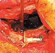 صورة طبية: مراجعة استبدال مفصل الورك الكلي بالقفص المضاد للبروز: حلول متقدمة لفقدان العظم الحقي الشديد مع الأستاذ الدكتور محمد هطيف في صنعاء