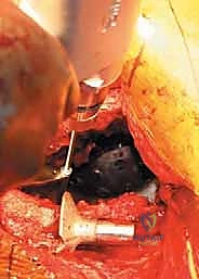 مراجعة استبدال مفصل الورك الكلي بالقفص المضاد للبروز: حلول متقدمة لفقدان العظم الحقي الشديد مع الأستاذ الدكتور محمد هطيف في صنعاء