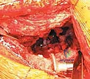 عملية استخراج المفصل القديم بحذر