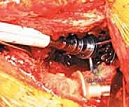 صورة توضيحية لـ مراجعة استبدال مفصل الورك الكلي بالقفص المضاد للبروز: حلول متقدمة لفقدان العظم الحقي الشديد مع الأستاذ الدكتور محمد هطيف في صنعاء