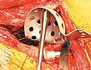 صورة توضيحية لـ مراجعة استبدال مفصل الورك الكلي بالقفص المضاد للبروز: حلول متقدمة لفقدان العظم الحقي الشديد مع الأستاذ الدكتور محمد هطيف في صنعاء