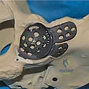 صورة طبية: مراجعة استبدال مفصل الورك الكلي بالقفص المضاد للبروز: حلول متقدمة لفقدان العظم الحقي الشديد مع الأستاذ الدكتور محمد هطيف في صنعاء