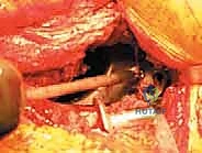 صورة طبية: مراجعة استبدال مفصل الورك الكلي بالقفص المضاد للبروز: حلول متقدمة لفقدان العظم الحقي الشديد مع الأستاذ الدكتور محمد هطيف في صنعاء