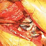 صورة توضيحية لـ مراجعة استبدال مفصل الورك الكلي بالقفص المضاد للبروز: حلول متقدمة لفقدان العظم الحقي الشديد مع الأستاذ الدكتور محمد هطيف في صنعاء