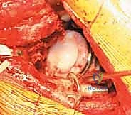 صورة توضيحية لـ مراجعة استبدال مفصل الورك الكلي بالقفص المضاد للبروز: حلول متقدمة لفقدان العظم الحقي الشديد مع الأستاذ الدكتور محمد هطيف في صنعاء