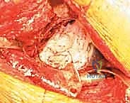 صورة توضيحية لـ مراجعة استبدال مفصل الورك الكلي بالقفص المضاد للبروز: حلول متقدمة لفقدان العظم الحقي الشديد مع الأستاذ الدكتور محمد هطيف في صنعاء