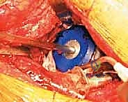 صورة توضيحية لـ مراجعة استبدال مفصل الورك الكلي بالقفص المضاد للبروز: حلول متقدمة لفقدان العظم الحقي الشديد مع الأستاذ الدكتور محمد هطيف في صنعاء