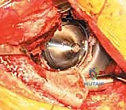 صورة توضيحية لـ مراجعة استبدال مفصل الورك الكلي بالقفص المضاد للبروز: حلول متقدمة لفقدان العظم الحقي الشديد مع الأستاذ الدكتور محمد هطيف في صنعاء