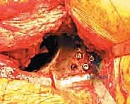 صورة توضيحية لـ مراجعة استبدال مفصل الورك الكلي بالقفص المضاد للبروز: حلول متقدمة لفقدان العظم الحقي الشديد مع الأستاذ الدكتور محمد هطيف في صنعاء