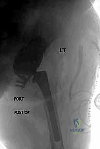 صورة طبية: مراجعة استبدال مفصل الورك الكلي بالقفص المضاد للبروز: حلول متقدمة لفقدان العظم الحقي الشديد مع الأستاذ الدكتور محمد هطيف في صنعاء