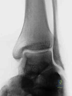 الفحص السريري والتصوير بالرنين المغناطيسي للكاحل