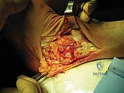 الأعراض السريرية لعدم استقرار الكاحل