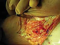 التشريح الدقيق لأربطة الكاحل الجانبية