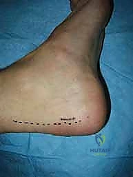 صورة توضيحية لـ إعادة بناء رباط الكاحل الجانبي المزمن بالطعوم الذاتية: خبرة الأستاذ الدكتور محمد هطيف في صنعاء