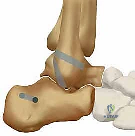 تثبيت الطعم الذاتي باستخدام البراغي التداخلية