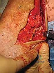 صورة توضيحية لـ إعادة بناء رباط الكاحل الجانبي المزمن بالطعوم الذاتية: خبرة الأستاذ الدكتور محمد هطيف في صنعاء