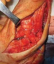 صورة توضيحية لـ إعادة بناء رباط الكاحل الجانبي المزمن بالطعوم الذاتية: خبرة الأستاذ الدكتور محمد هطيف في صنعاء