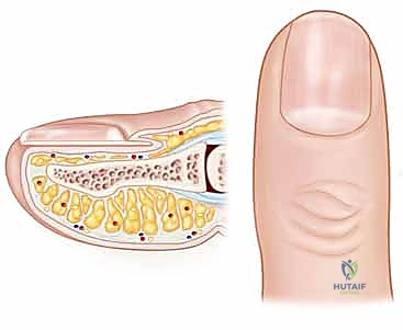 Illustration of paronychia and felons - Dr. Mohammed Hutaif