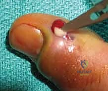 تأثير التهاب الجمرة الخبيثة على عظام الإصبع