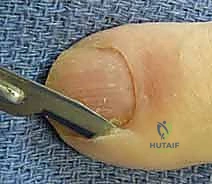 التهابات الأصابع: دليل شامل لعلاج الداحس والجمرة الخبيثة مع الأستاذ الدكتور محمد هطيف