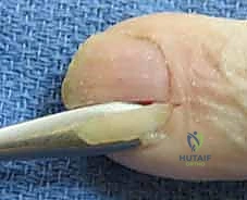 أدوات العلاج التحفظي والعناية الأولية بالإصبع