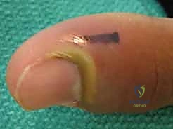 الدكتور محمد هطيف أثناء إجراء تدخل جراحي دقيق