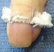 عملية غسيل وتنظيف الجرح من الداخل