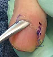 إجراء الشق الجراحي لتصريف الصديد من الإصبع