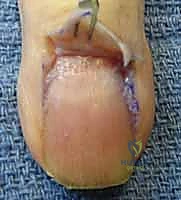 التهاب الجمرة الخبيثة في باطن الإصبع (Felon)