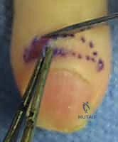 رسم توضيحي لتشريح الإصبع والأوتار