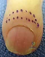 توجيهات العناية بالجرح والضمادات بعد العملية