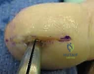 صورة توضيحية لـ التهابات الأصابع: دليل شامل لعلاج الداحس والجمرة الخبيثة مع الأستاذ الدكتور محمد هطيف