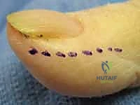 صورة توضح الفرق بين الجرح قبل وبعد التدخل الجراحي