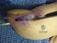 تخدير الإصبع الموضعي (Digital Block)