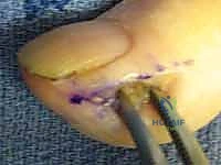 صورة توضيحية لـ التهابات الأصابع: دليل شامل لعلاج الداحس والجمرة الخبيثة مع الأستاذ الدكتور محمد هطيف