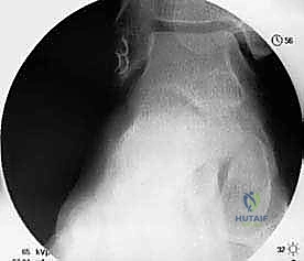 التحضير لعملية الكاحل في غرفة العمليات المجهزة